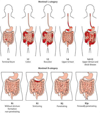 Montreal L-category L4+L3 Ileocolon GI tract and Upper Gl tract distal disease Montreal B-category Ll L2 Terminal ileum Without stricture formation non-penetrating Stricturing B3P 83 Perianally penetrating Penetrating 
