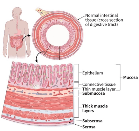 Normal intestinal tissue (cross section of digestive tract) Epithelium Thin muscle layer Submucosa Thick muscle layers Su bserosa Serosa Mucosa 