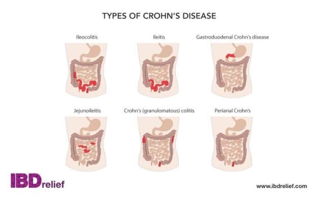 TYPES OF CROHN'S DISEASE Ile0C01itiS Jejunoileitis Ileitis Crohn•s (granulomatous) colitis relief Gastroduodenal Crohn's disease Perianal Crohn's www.ibdrelief.com 